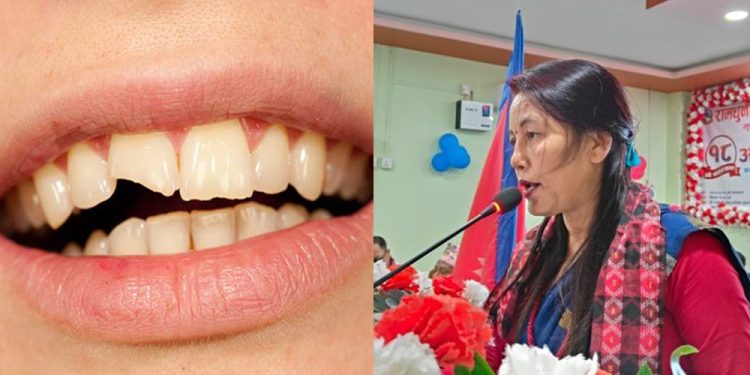 जेष्ठ नागरिकको दाँत रामधुनी नगरपालिकाले बनाइदिने, १० लाख बजेट विनियोजन